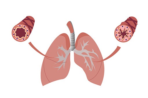 dr elisabeth leko mohr image asthma bronchiale 02